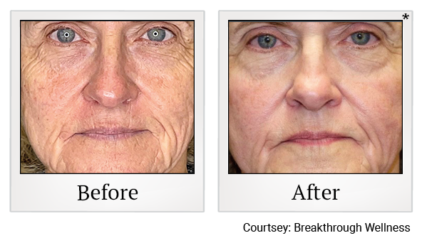 Results 27 of EmFace treatment at True Form Medical Group in Oakland and Fremont