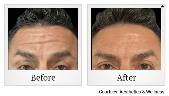 Results 2 of EmFace treatment at True Form Medical Group in Oakland and Fremont