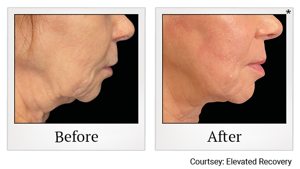 Results 5 of EmFace treatment at True Form Medical Group in Oakland and Fremont