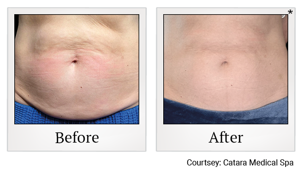 Results 3 of emsculpt neo treatment at True Form Medical Group in Oakland and Fremont