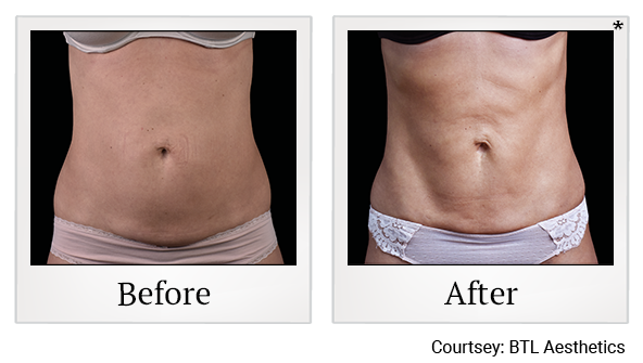 Results 2 of emsculpt neo treatment at True Form Medical Group in Oakland and Fremont