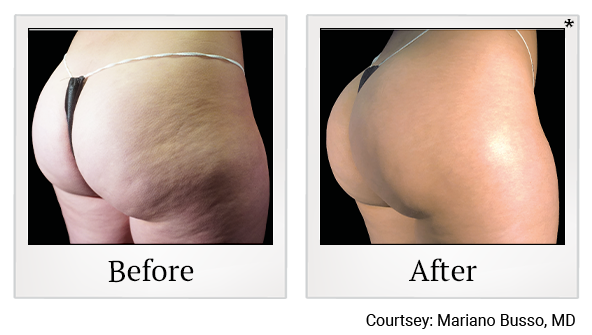 Results 14 of emsculpt neo treatment at True Form Medical Group in Oakland and Fremont