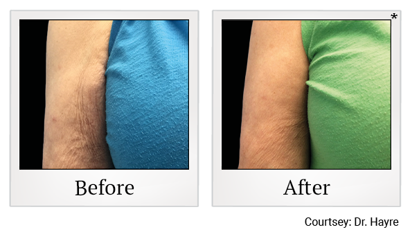 Results 5 of emtone treatment at True Form Medical Group in Oakland and Fremont